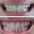 Отзыв о Отбеливающие полоски Dr.Kogel: Полоски рабочие