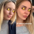 Отзыв о Пластический хирург Максим Иванчук: Закрытая ринопластика